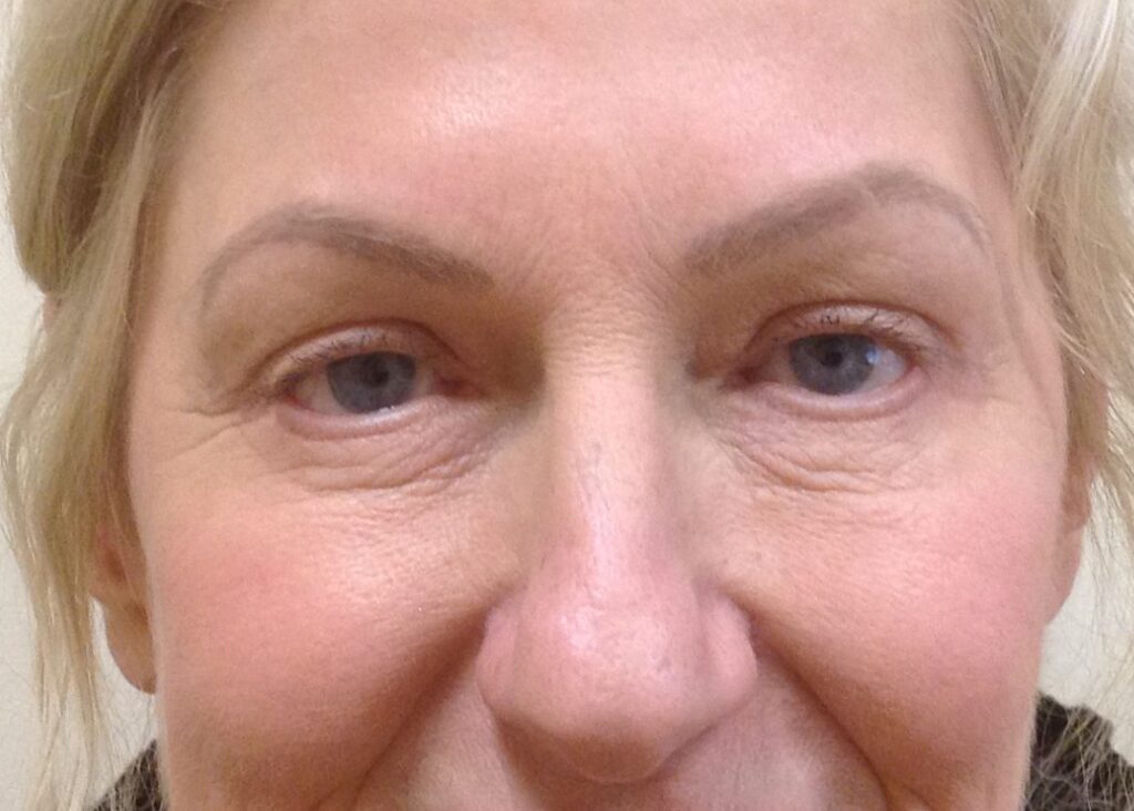 Upper Lower Blepharoplasty Months Post Op Rob Winterton